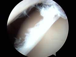 hiparthroscopy-intraoppic1.png